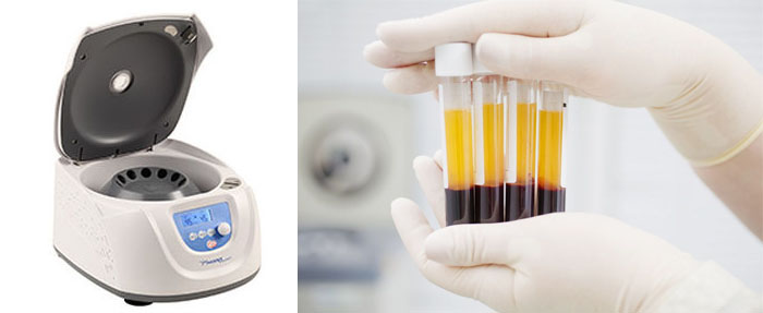 Centrifugation du Plasma Riche en Fibrine