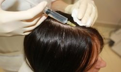 injection i-prf dans les cheveux