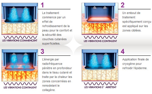 Le mode de fonctionnement du Thermage