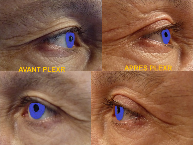 Photo avant après de blépharoplastie sans chirurgie par technique Plexr