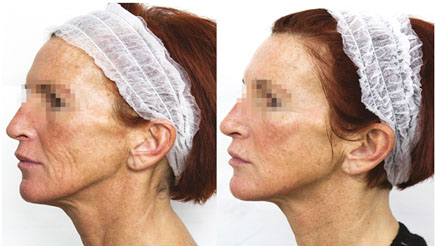 Photo avant après peeling de biorevitalisant PRXT-33