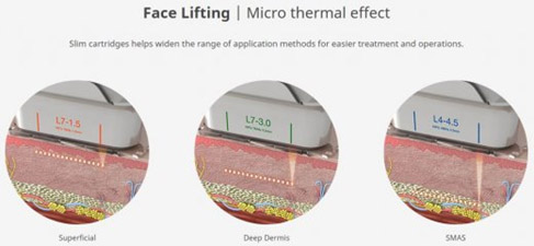 Profondeur du traitement par Ultrashape III