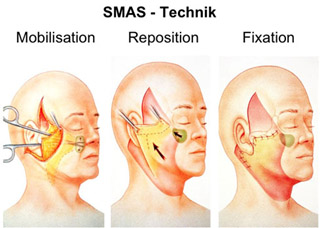 smas