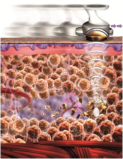 Ultrashape V3 : élimination des cellules graisseusses