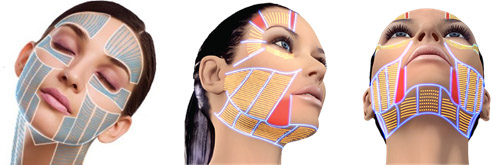 Zones de traitement du visage par Ultraformer III